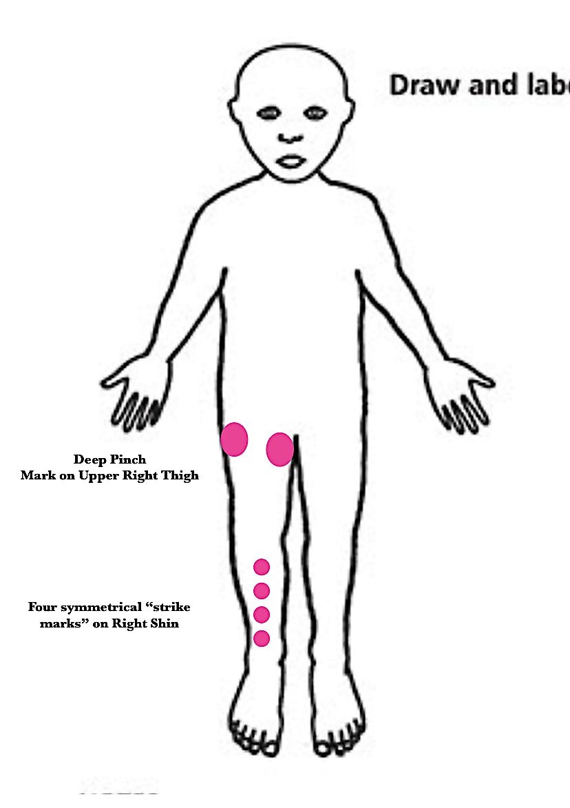 Contemporaneous body diagram of a child's outline. Two pink dots on upper right thigh labeled 'Deep Pinch Mark on Upper Right Thigh.' Four pink dots in a vertical line on the right shin labeled 'Four symmetrical strike marks on Right Shin.' Created at the time of Visit 15, March 31, 2019.